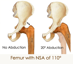 Abduction with an FNSA of 110