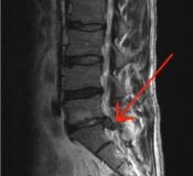 An MRI image showing a herniated disk